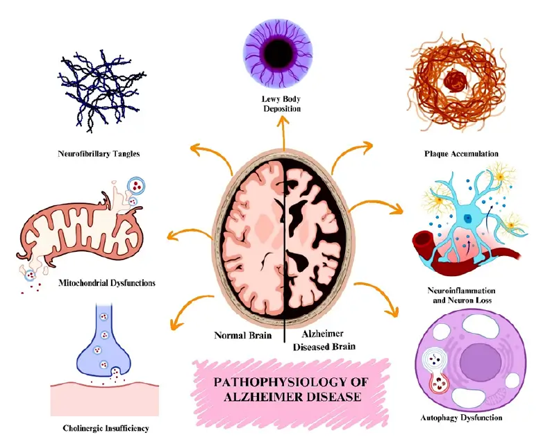 Amyloid Beta and Tau Aggregation Amyloid Beta and Tau Aggregation